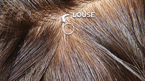 Louse in the hair