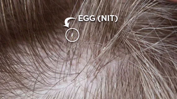 Egg, Nit, on hair strand